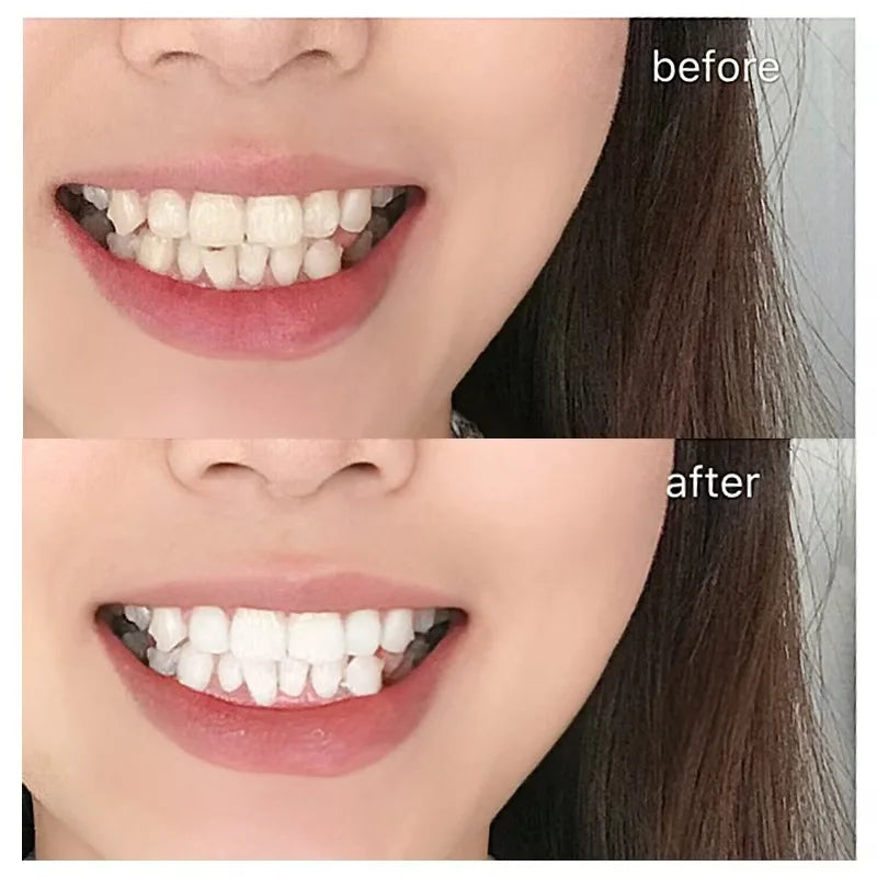 Lumelle Care Teeth Whitening Strips – 7 Day Treatment